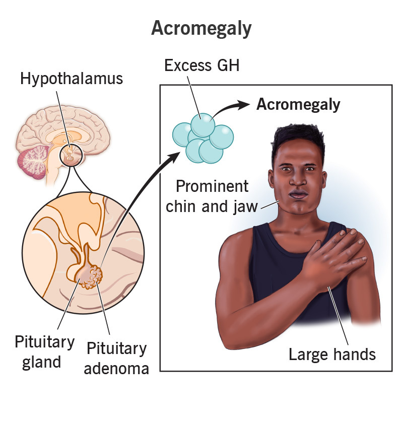 Understanding Acromegaly and Its Treatment Options